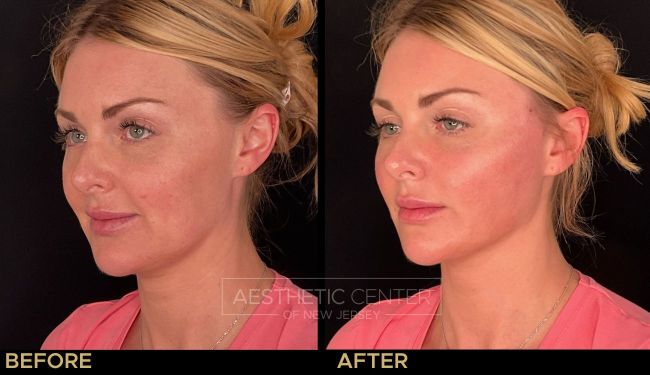 Full face PDO thread lift on a young woman for lifting and tightening. 