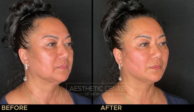 Full face PDO thread lift on a woman, focusing on lower face.