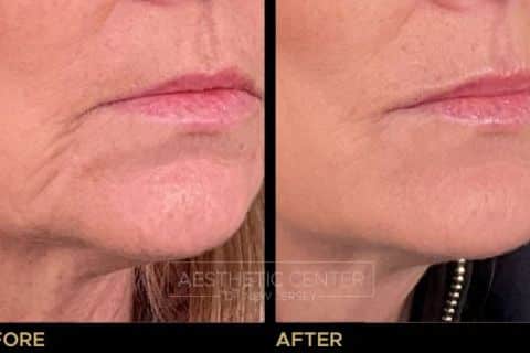 Marionette Line Filler Before & After 