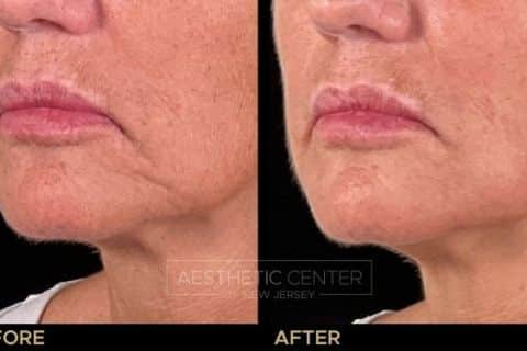 Marionette Line Filler Before & After 