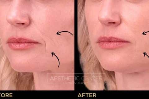Smile & Marionette Line Filler Before & After 