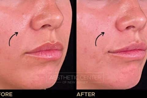Smile Line/Pyriform Aperture Filler Before & After 