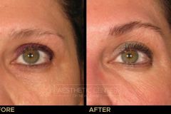 Ultherapy brow lift  before and after for skin lifting and tightening.
