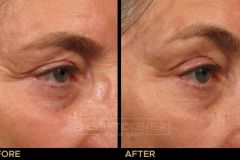 Ultherapy brow lift  before and after for skin lifting and tightening.