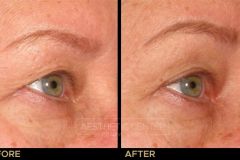 Ultherapy brow lift  before and after for skin lifting and tightening.