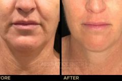Ultherapy B&A - 18