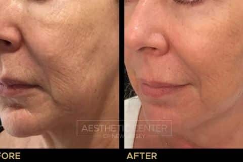 Ultherapy lower face before and after for skin lifting and tightening.