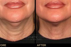 Ultherapy neck before and after for skin lifting and tightening.