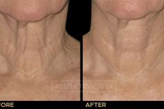 Ultherapy neck before and after for skin lifting and tightening.