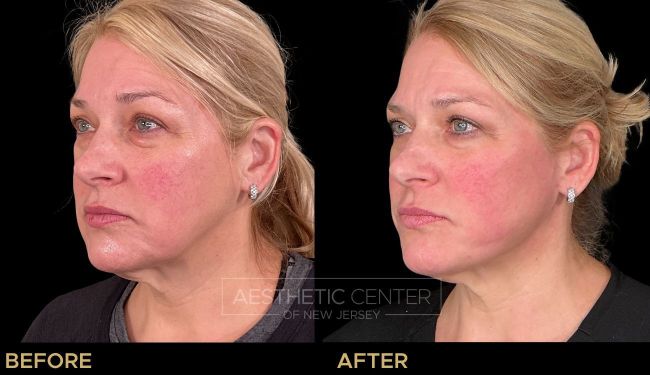 Ultherapy & PDO Threads combo before and after for skin lifting and tightening.