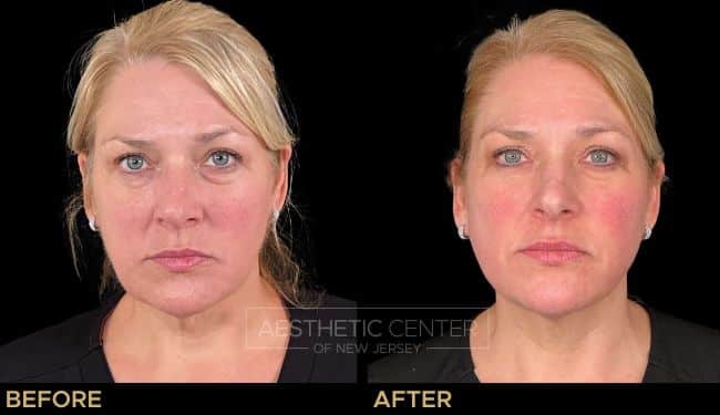 Ultherapy & PDO Threads combo before and after for skin lifting and tightening.