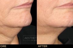 Ultherapy under chin before and after for skin lifting and tightening.