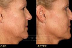 Ultherapy under chin before and after for skin lifting and tightening.