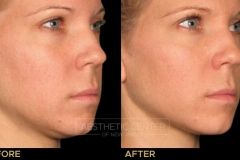 Ultherapy under chin before and after for skin lifting and tightening.