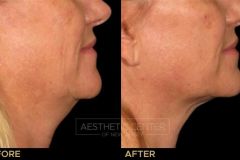 Ultherapy under chin before and after for skin lifting and tightening.
