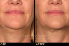 Ultherapy under chin before and after for skin lifting and tightening.