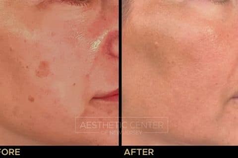 Before & after laser treatments for sun damage and sun spots.