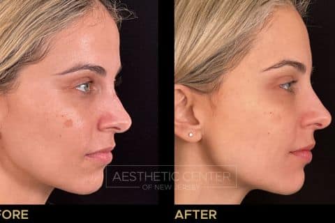 Before & after laser treatments for sun damage and sun spots.
