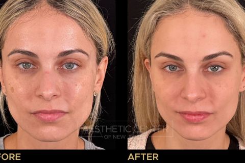 Before & after laser treatments for sun damage and sun spots.