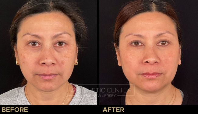Before & after laser treatments for sun damage and melasma.