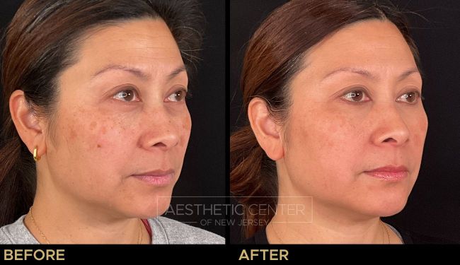Before & after laser treatments for sun damage and melasma.