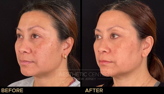 Before & after laser treatments for sun damage and melasma.