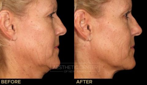 Before & after result of Ultherapy on woman's under chin area, side view.