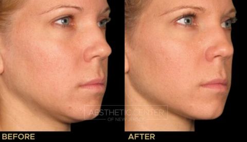Before & after result of Ultherapy on young woman's under chin area.