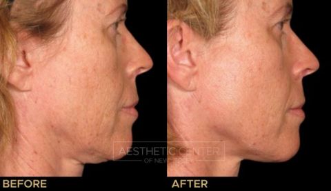 Before & after result of Ultherapy on woman's under chin area, side view.