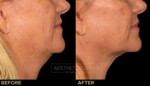 Before & after result of Ultherapy on woman's under chin area, side view.
