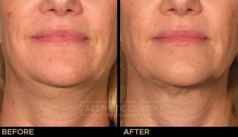 Before & after result of Ultherapy on woman's under chin area, front view.