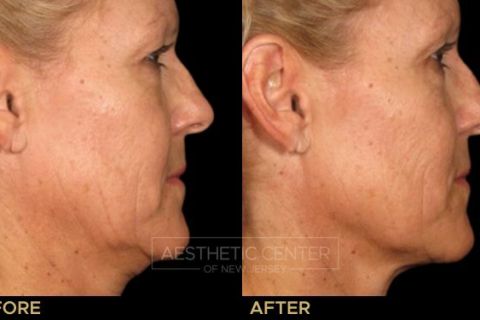 Before & after result of Ultherapy on woman's under chin area, side view.