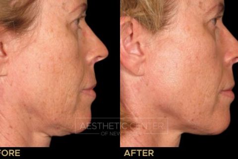 Before & after result of Ultherapy on woman's under chin area, side view.