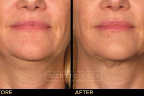 Before & after result of Ultherapy on woman's under chin area, front view.