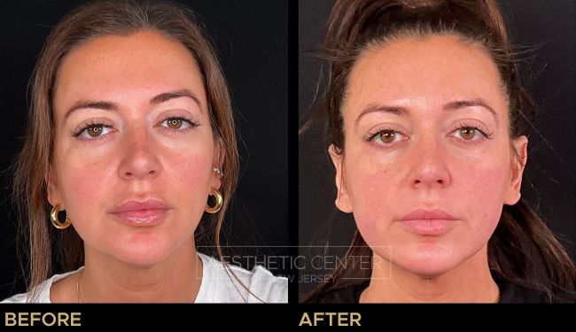 Under eye PRF BioFiller (eZ Gel) natural filler alternative