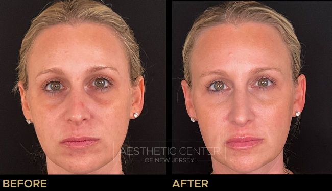 Under eye PRF BioFiller (eZ Gel) natural filler alternative