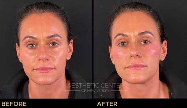 Under eye PRF BioFiller (eZ Gel) natural filler alternative