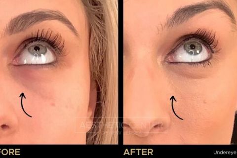 Under eye filler / tear trough filler 01