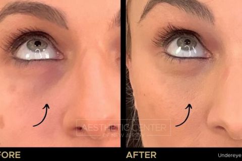 Under eye filler / tear trough filler 02