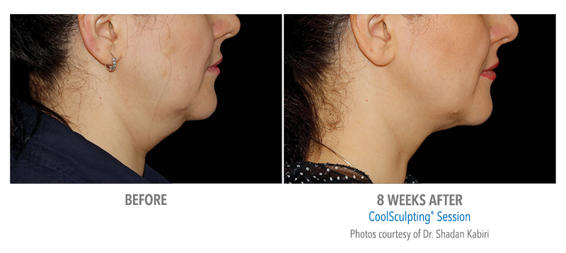 Before and after of CoolSculpting for double chin.