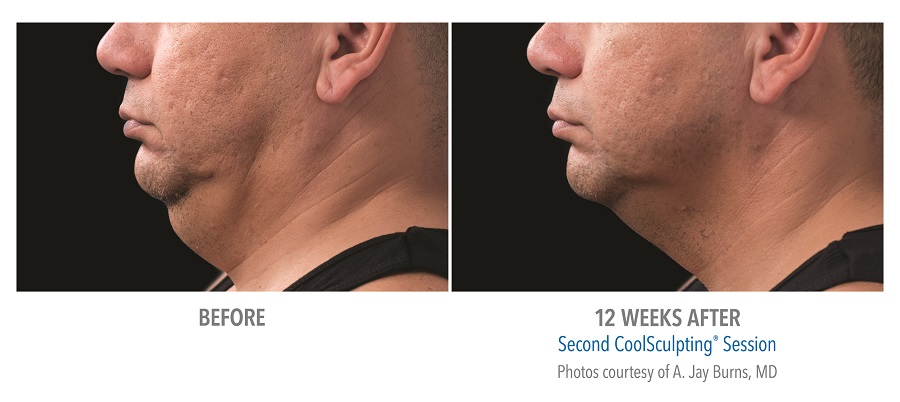 Before and after of CoolSculpting for double chin in Franklin Lakes, NJ.