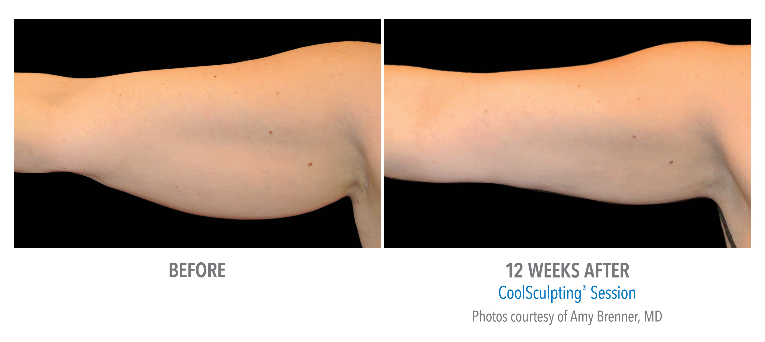 Can CoolSculpting Reduce Underarm Breast Tissue? - NJ Center for  CoolSculpting