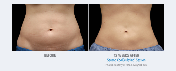 CoolSculpting Stoney Creek, CoolSculpting Near Me