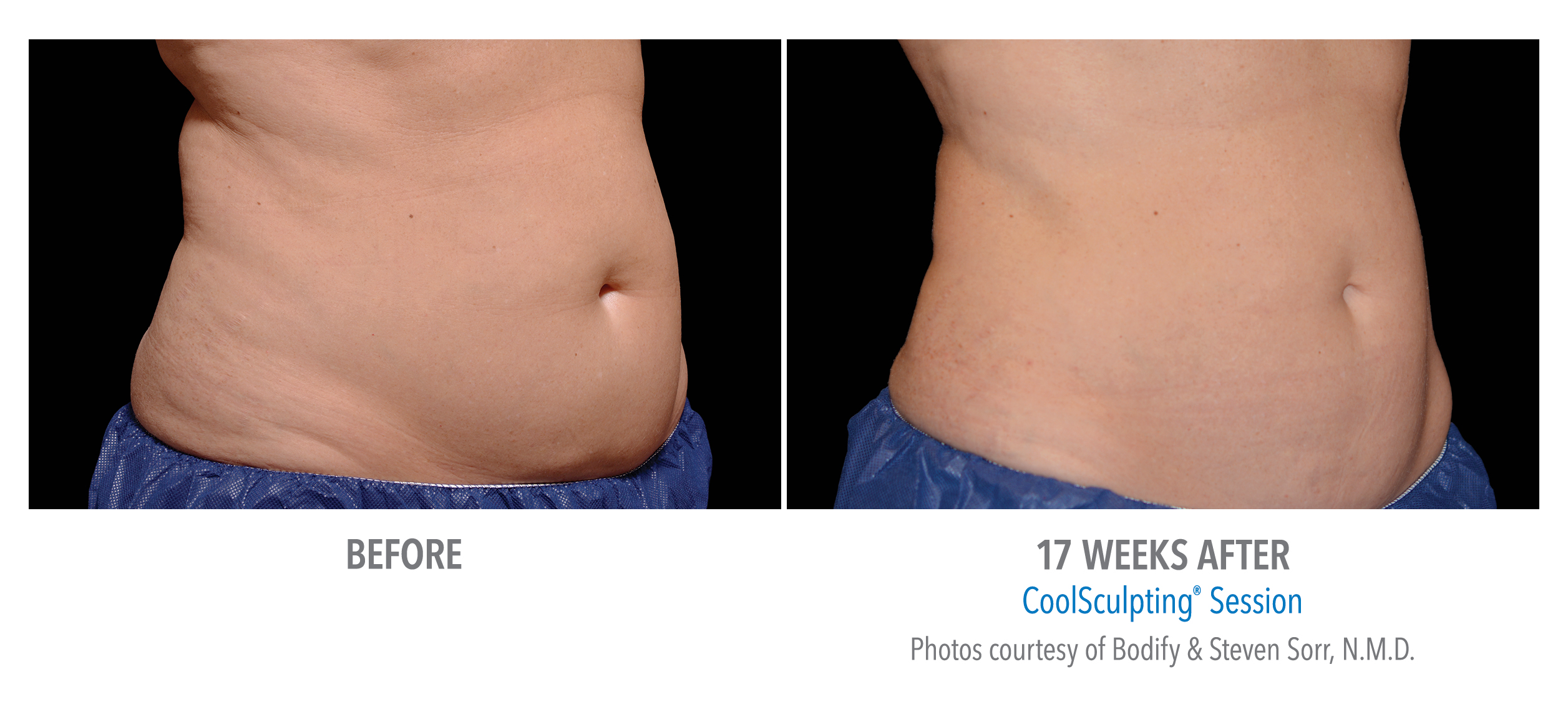 CoolSculpting - Aesthetic Center of New Jersey