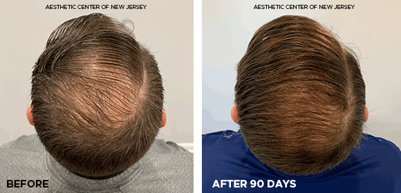 Hair loss hot sale nj