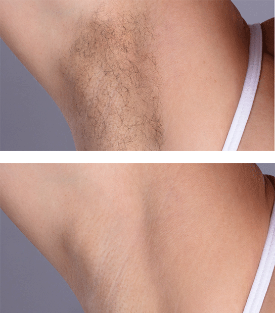 Laser Hair Removal Aesthetic Center of New Jersey