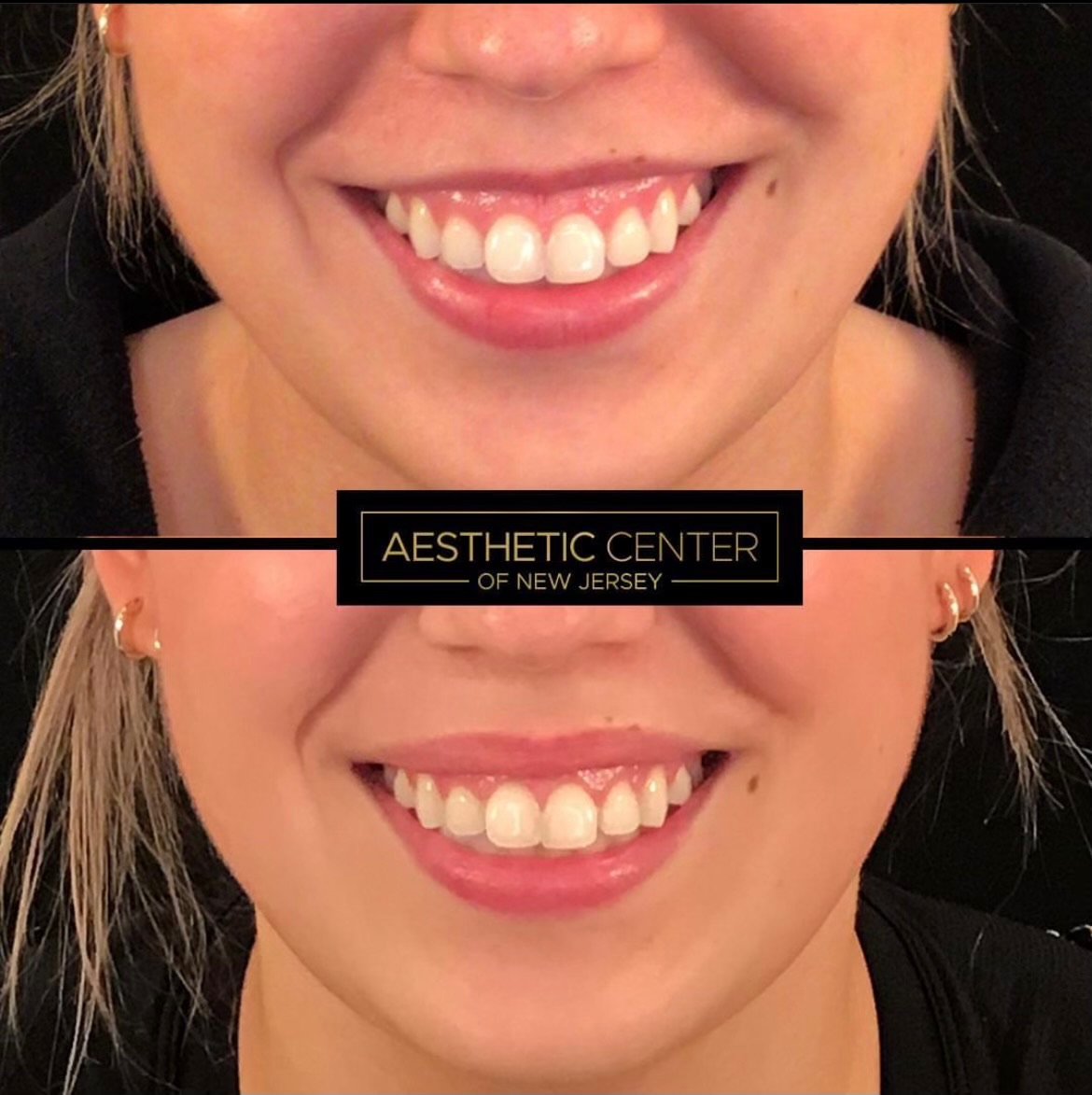 Lip flip before and after on young female with gummy smile