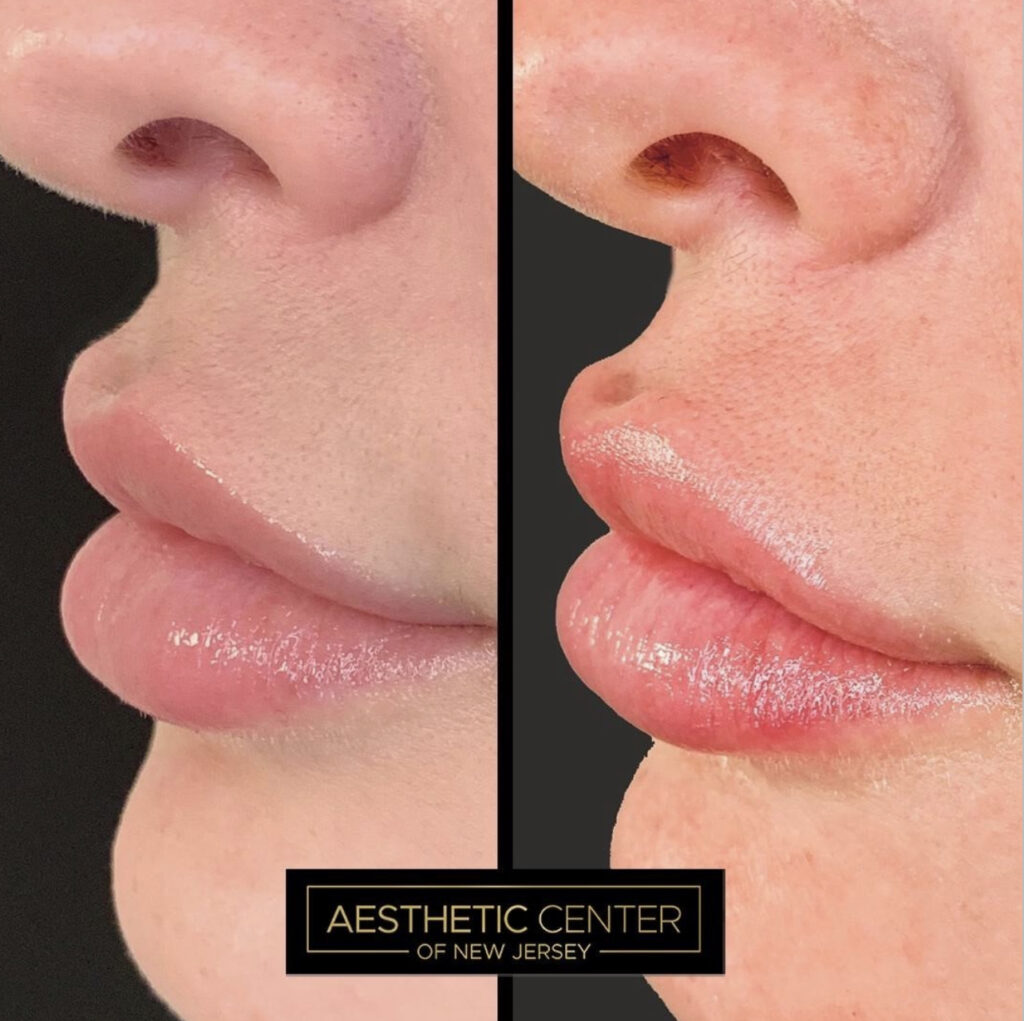 Botox lip flip pout before and after results on young female.