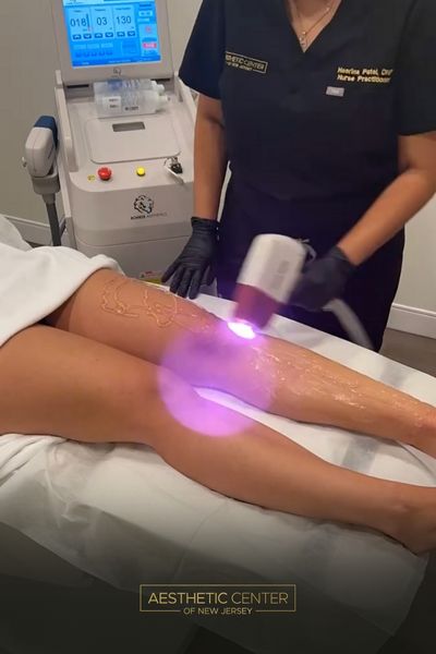 Laser hair removal treatment on legs