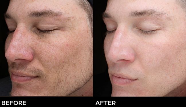 Before and after result of a young man treated with a VI chemical peel.